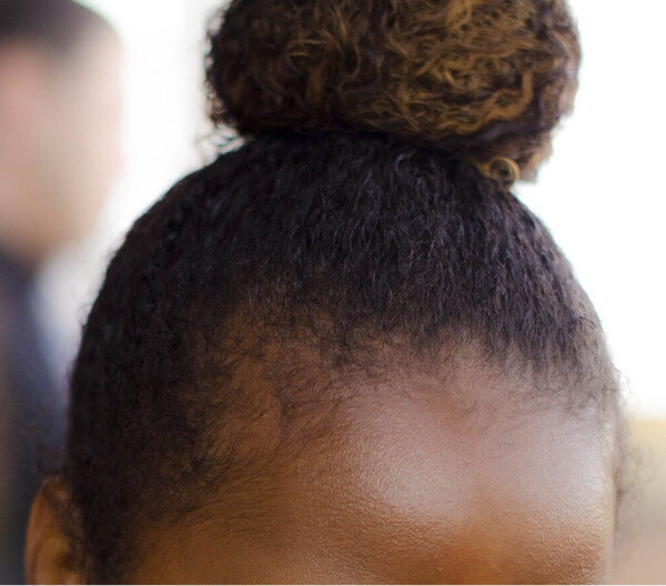 How I Grew My Edges Back and Treated a Thinning Hairline - FroHub